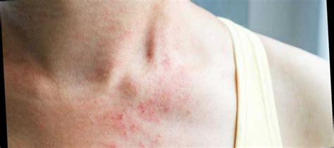 A Skin Rash May Be A New Rare Symptom Of Coronavirus According To