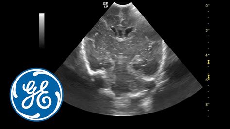 Neonatal Head Ultrasound