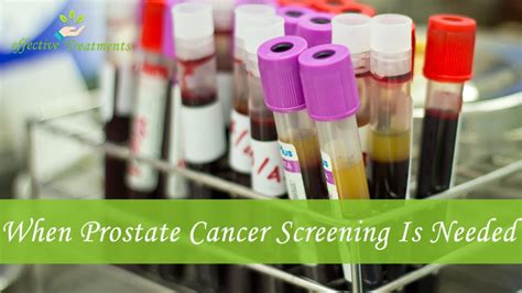 Prostate Cancer Screenings The Ultimate PSA Guide