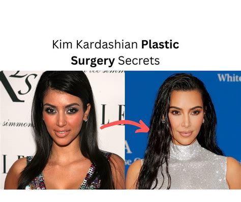 Kim Kardashian Plastic Surgery Before And After 2022