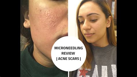 Microneedling Review Acne Scars Before And After Part 1 Youtube