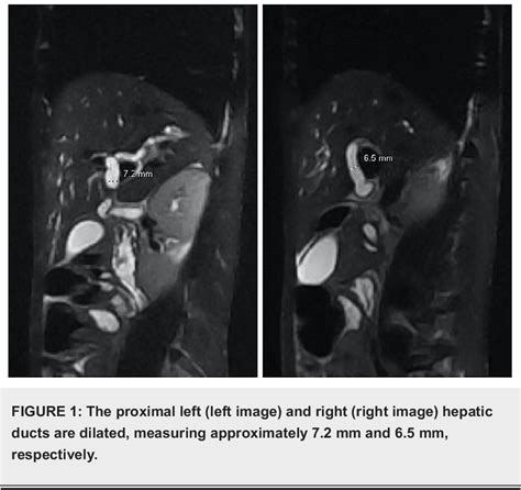 figure 1 from magnetic resonance cholangiopancreatography mrcp findings in a patient with aids