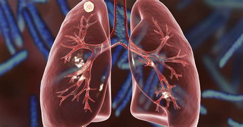 Lung Nodules And How They Relate To Lung Cancer El Camino Health