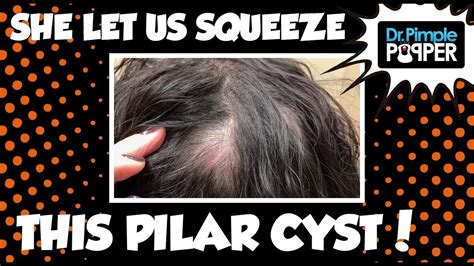 She Let Us Squeeze This Pilar Cyst Youtube
