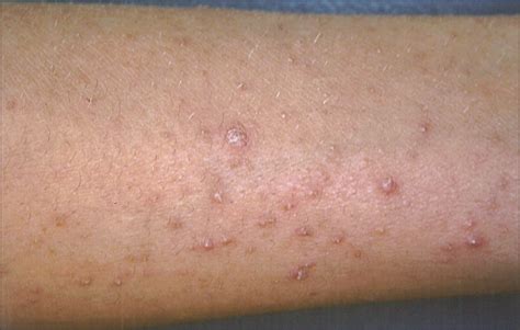 Follicular Eruption On Arms And Legs—quiz Case Dermatology Jama