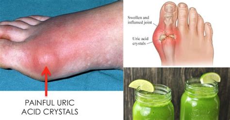 How To Quickly Remove Uric Acid Crystalization From Your Body To