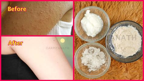 How Do I Get Rid Of Bumps On My Arms Acne Care Is A Natural Herbal