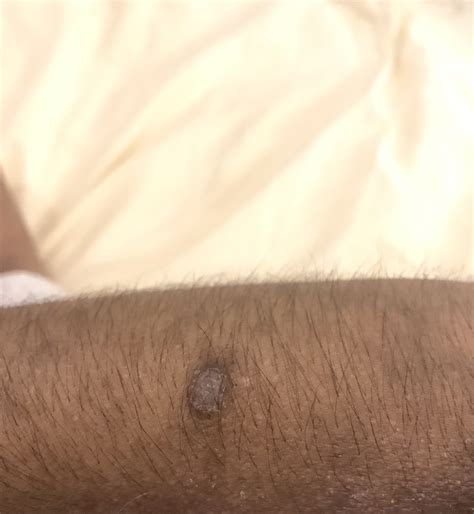 What Is This On My Arm That Never Goes Away And Has Been There For A