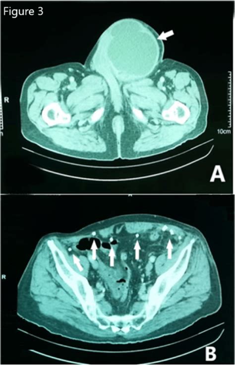 Abdomen And Pelvic Ct Scan Showing A A Large Abscess On The Left