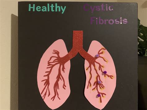 Cystic Fibrosis And The Epithelial Tissue That Lines The Lungs Human Steam