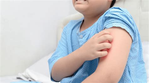 Rashes In Kids—when To Worry Hamilton Health Sciences