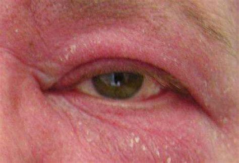 Ocular Rosacea Symptoms And Treatment