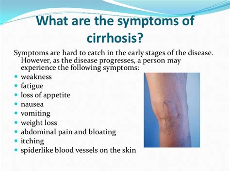 Symptoms Of Symptoms Cirrhosis Of The Liver