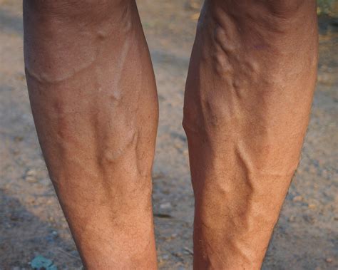 Varicose Veins What Are They And Should I Be Concerned Vein Center