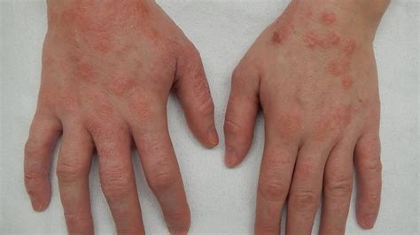 Dermatitis Herpetiformis Causes Symptoms Diagnosis Treatment Medicine Com