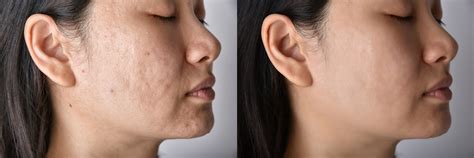 Removing Acne Scars Using Pico Laser In Singapore