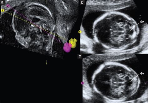 Open Fourth Ventricle Prior To 20 Weeks Gestation A Benign Finding