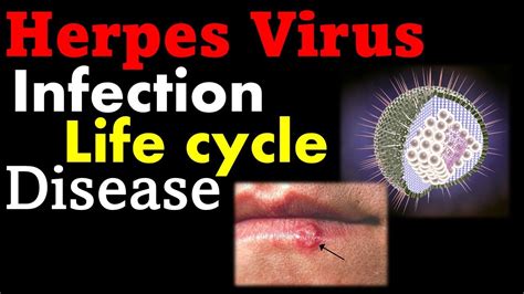 Herpes Virus Infection And Treatment Youtube