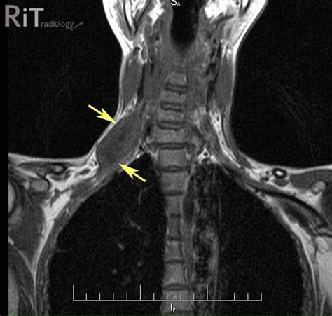 Rit Radiology Primary Brachial Plexus Tumor