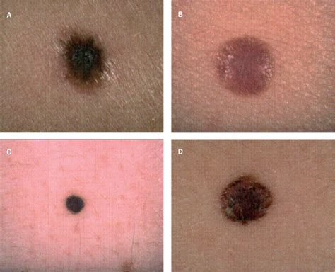 Nodular Melanoma Skin Cancer