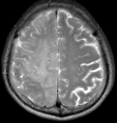 Brain Mri That Showing Signs Of Recent Infarct With Diffuse Swelling