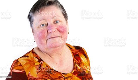 Portrait Of Smiling Elderly Woman With Skin Disease Rosacea No Makeup