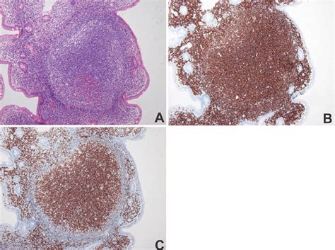 Figure 2 From Small Intestinal Follicular Lymphoma With Multiple Tumor