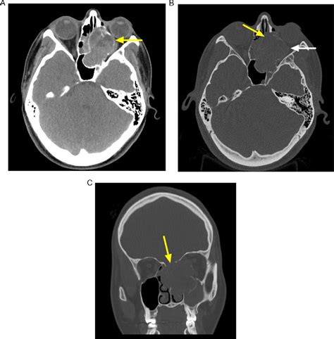 Figure 1 From A Rare Case Of Sino Nasal Aneurysmal Bone Cyst Semantic