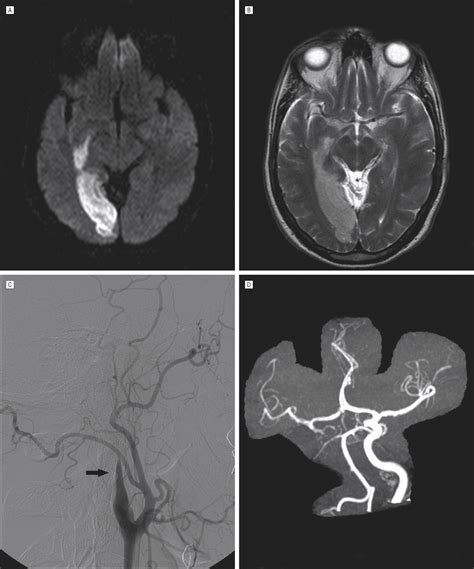 Isolated Posterior Cerebral Artery Infarction Caused By Carotid Artery