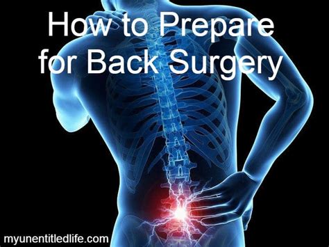 How To Prepare For Back Surgery