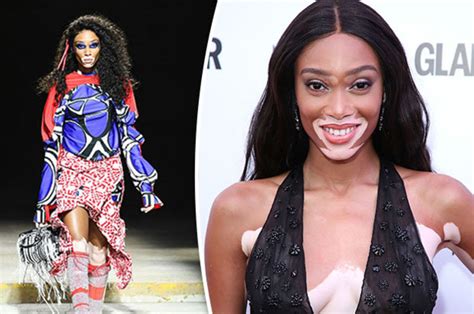Winnie Harlow At Lfw Everything You Need To Know About Her Skin