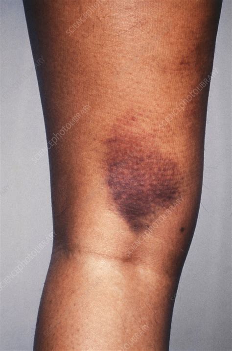 Bruise On Leg Stock Image C0270657 Science Photo Library