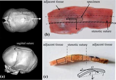 Mechanical Properties Of Fused Sagittal Sutures In Scaphocephaly