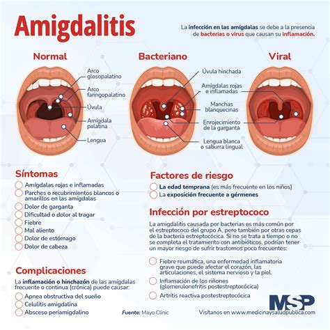 Amigdalitis Infografía