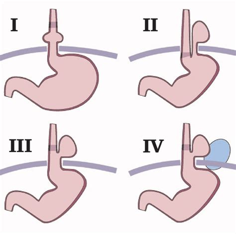 Figure 1 From Classification Of Hiatal Hernias Using Dynamic Three