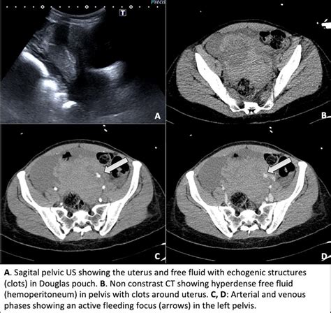 Hemoperitoneum Secondary To Ruptured Ovarian Cyst A Tricky Diagnosis