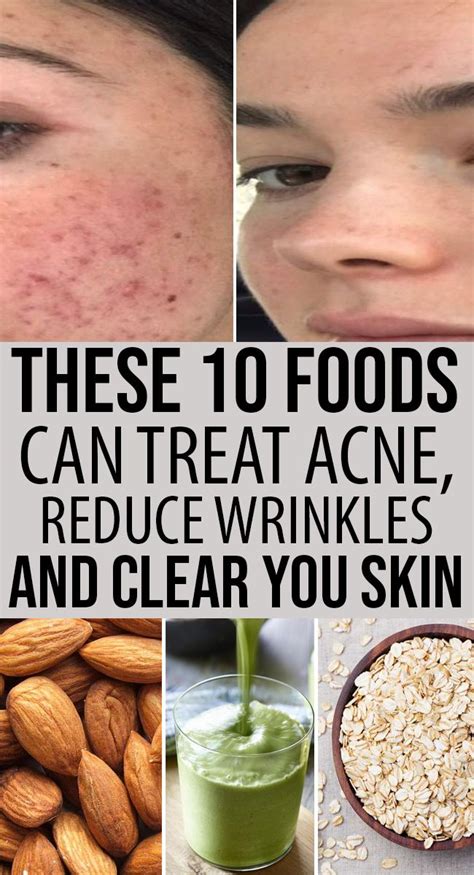 Revealed The 10 Best Foods To Eat To Treat Acne And Get Clear Skin