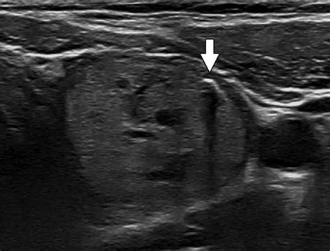 Peripheral Thyroid Nodule Calcifications On Sonography Evaluation Of