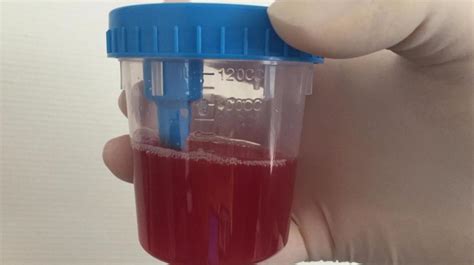It is normally removed from the blood by the liver. Pus Cells In Urine Normal Range Hpf In Pregnancy