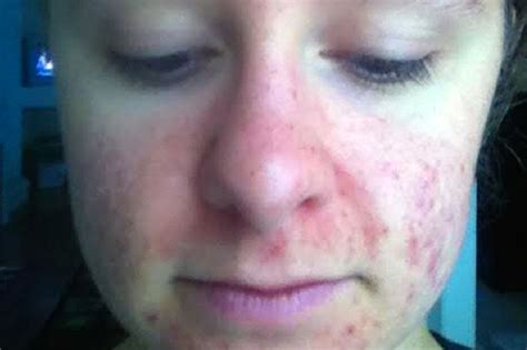 Acne Ravaged Girl Too Terrified To Look In The Mirror Claims She Beat