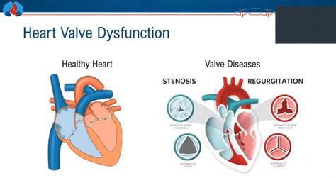 Improving The Diagnosis Of Heart Valve Disease Monash Institute Of