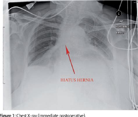 Figure 1 From Hiatal Hernia Causing Extrapericardial Tamponade After