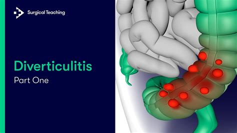 Diverticulitis Part 1 What Is It And What Causes It Youtube