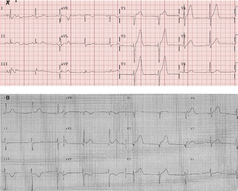 Dr Smiths Ecg Blog Lvh With Anterior St Elevation When Is It