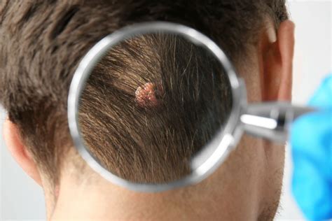 Moles On Scalp Causes And Treatments Beverly Hills Md