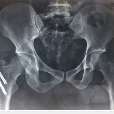 Post Operative Plain Radiograph Of The Pelvis With Bilateral