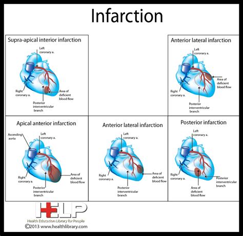 Infarction Human Anatomy And Physiology Nursing Notes Cardiac Nursing