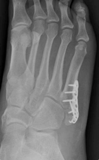 5th Metatarsal Fracture