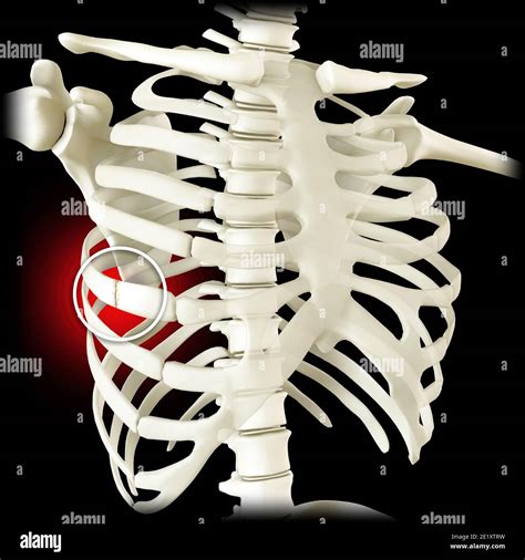 Anatomy And The Human Body Costochondral Separation Separated Rib