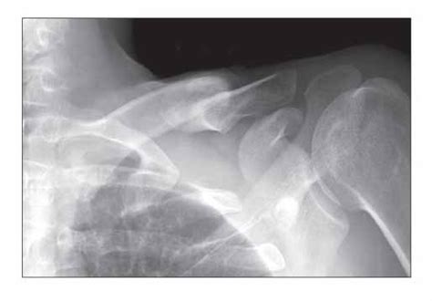 Surgical Treatment Of Thoracic Outlet Syndrome Secondary To Clavicular